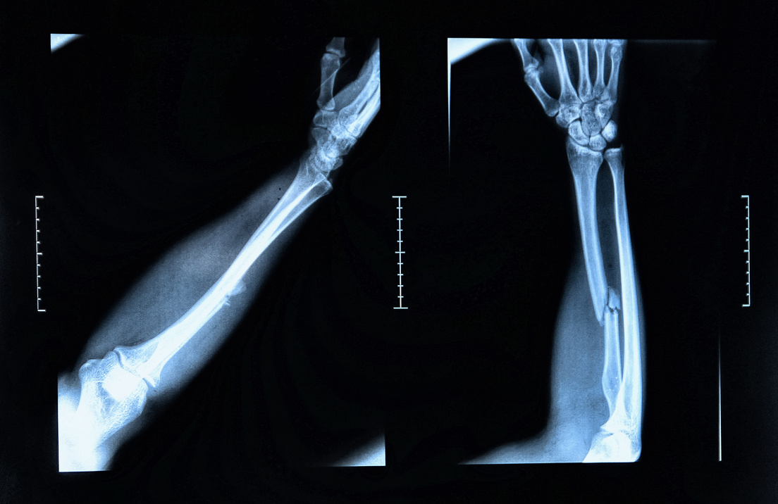 Arm fracture seen on x-ray